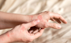 Wie die Rotlichttherapie bei Psoriasis hilft: Natürliches entzündungshemmendes Mittel